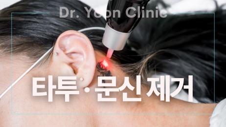 타투 문신제거 썸네일